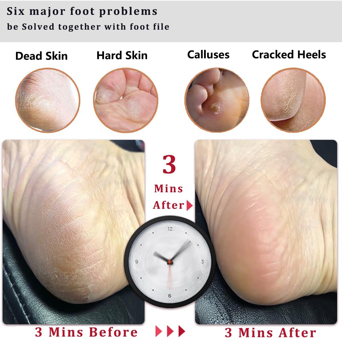 Kinepi Callus Remover Foot File, Pumice Stone for Feet Scrubber Wet and Dry
