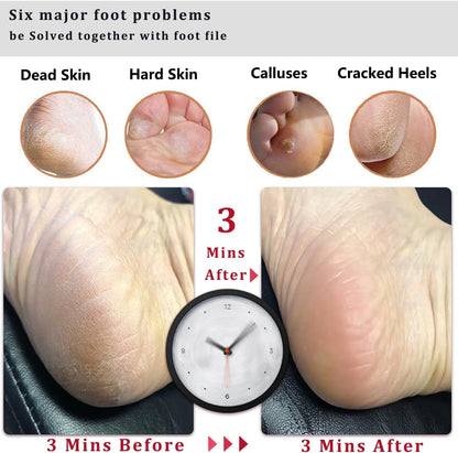 Kinepi Callus Remover Foot File, Pumice Stone for Feet Scrubber Wet and Dry
