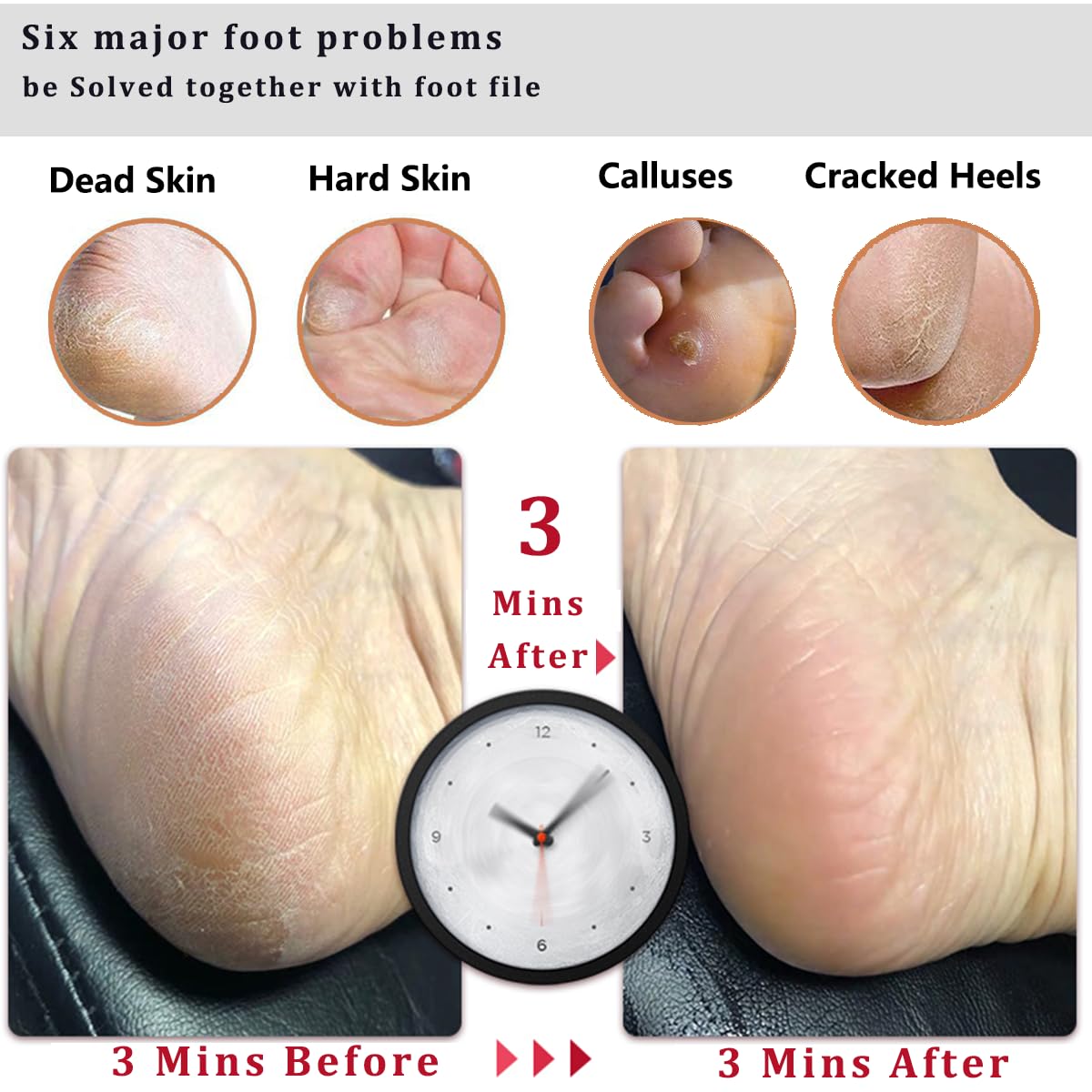 Kinepi Foot File & Foot Scrubber,Pumice Stone for Feet Callus Remover