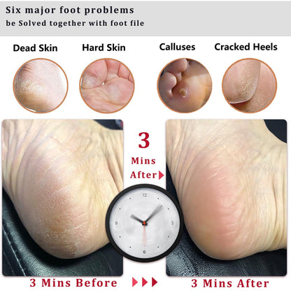 Kinepi Foot File & Foot Scrubber,Pumice Stone for Feet Callus Remover